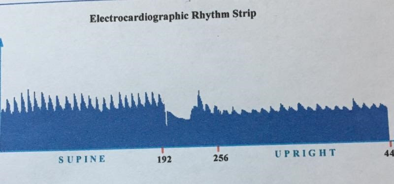Electrocardiographic rhythm strip showing normal Heart Rate Variability, or HRV.