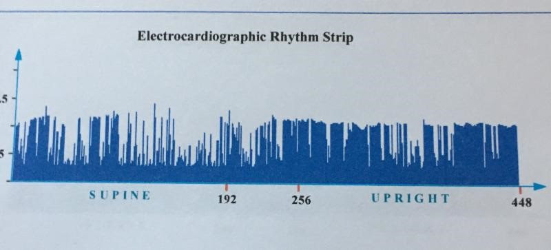 Close-up view of an ECG rhythm strip illustrating disrupted Heart Rate Variability, or HRV.