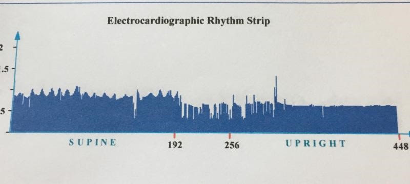 Detailed electrocardiographic tracing highlighting irregular HRV.