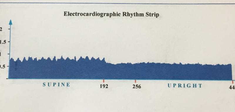 ECG rhythm strip displaying improved HRV.